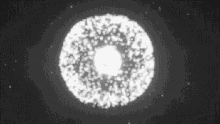 干细胞移植治疗乙型肝炎肝硬化临床研究